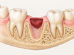 Cross-section of a lower jaw after wisdom tooth removal, showing the empty molar socket with its protective blood clot, pink gum tissue closing around the opening, and surrounding jawbone during early healing.